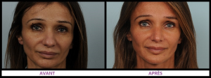Rhinoplastie ultrasonique