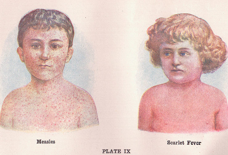 retour rougeole europe-Metropolitaine